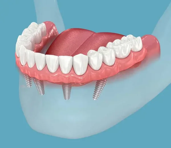 D-Darstellung einer Zahnprothese, die mit vier Implantaten im Unterkiefer befestigt ist.