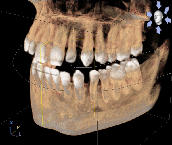 Röntgenaufnahme 3D DVT AllDent 