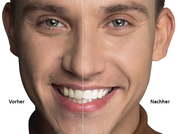 Bleaching Ergebnis AllDent