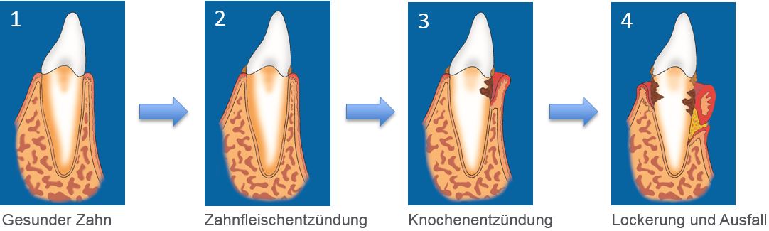 Parodontitis Zahnfleisch und Zahn 
